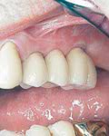 Implantate mit eingegliederter Brücke